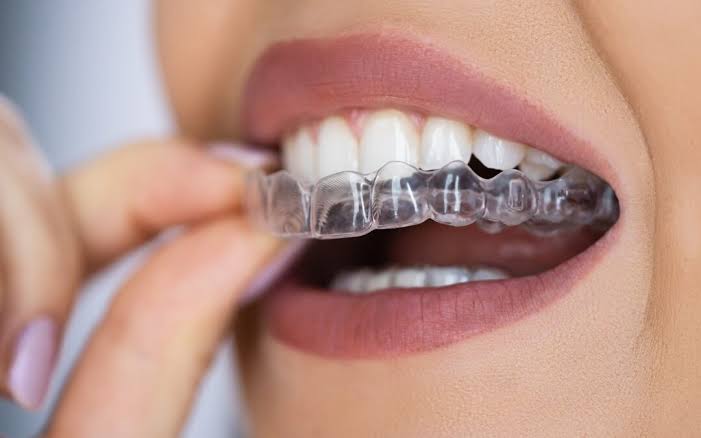 Clear Aligners in Pune