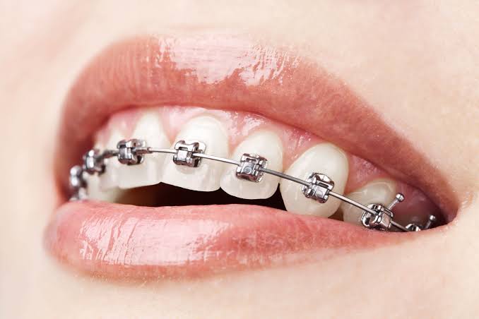 Braces in Pune