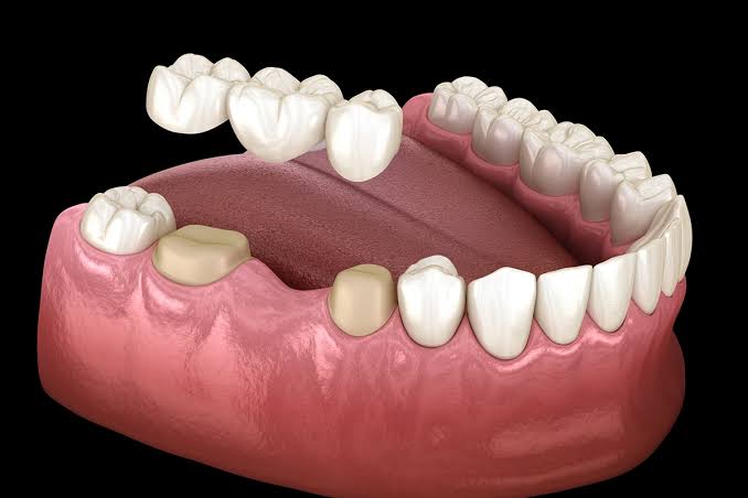 Dental Bridge in Pune
