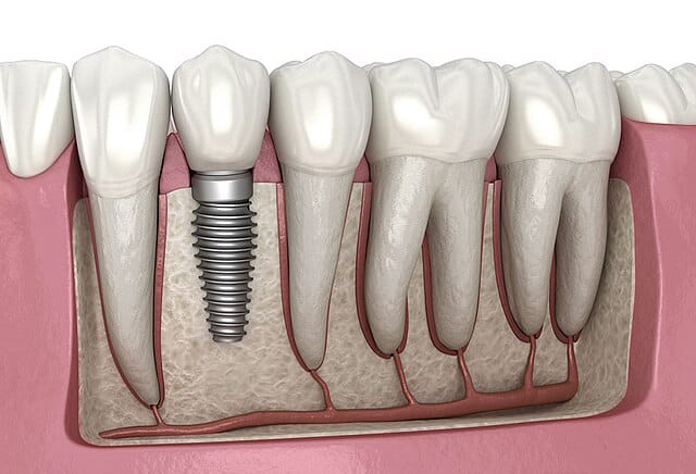 Dental Implants in Pune