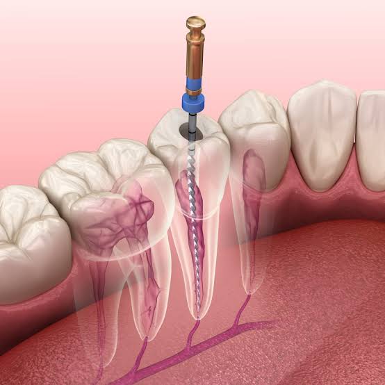 Root Canal Treatment in Pune