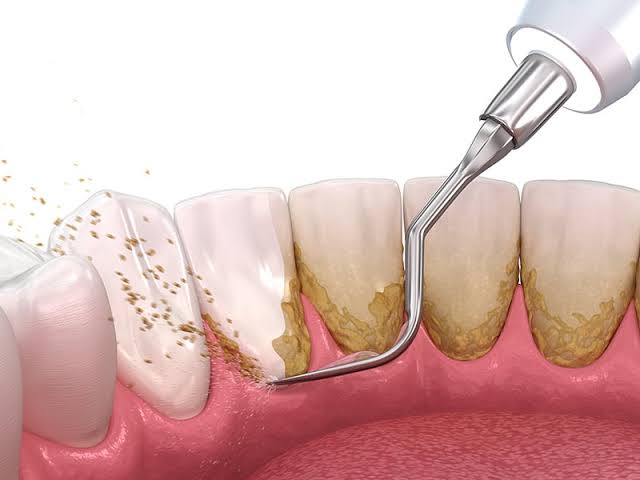 Teeth Cleaning & Polishing in Pune