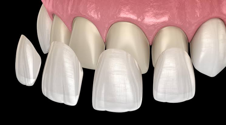 Veneers in Pune