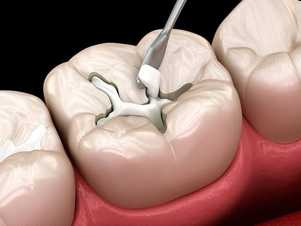 Dental Filling in Pune
