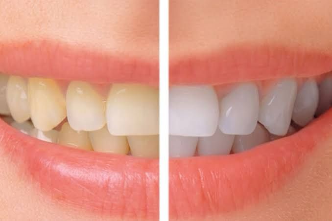 Teeth Whitening in Pune